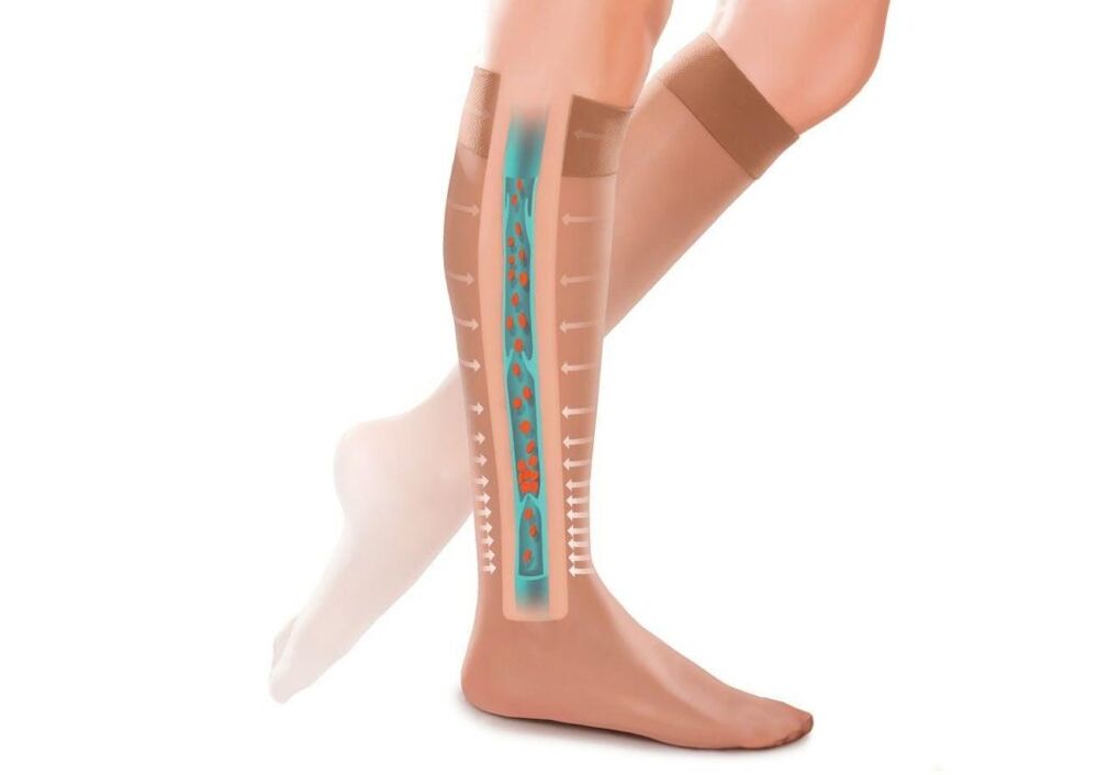 ang epekto ng compression stockings sa mga binti na may varicose veins