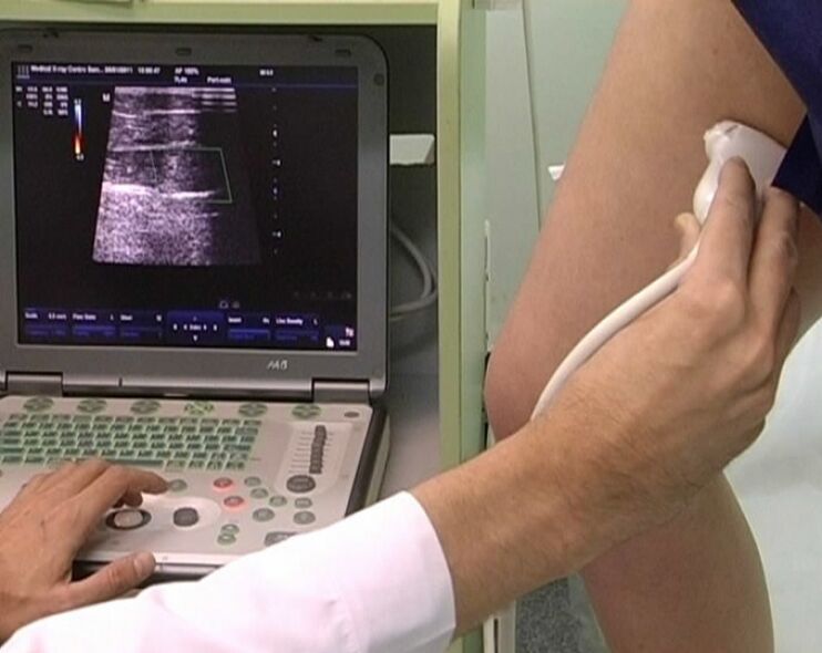 ultrasound diagnosis ng pelvic varicose veins