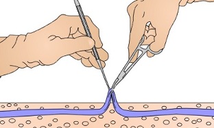 operasyon para sa varicose veins